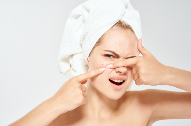 Oily Skin Prone to Pimples – How to Prevent Acnes?