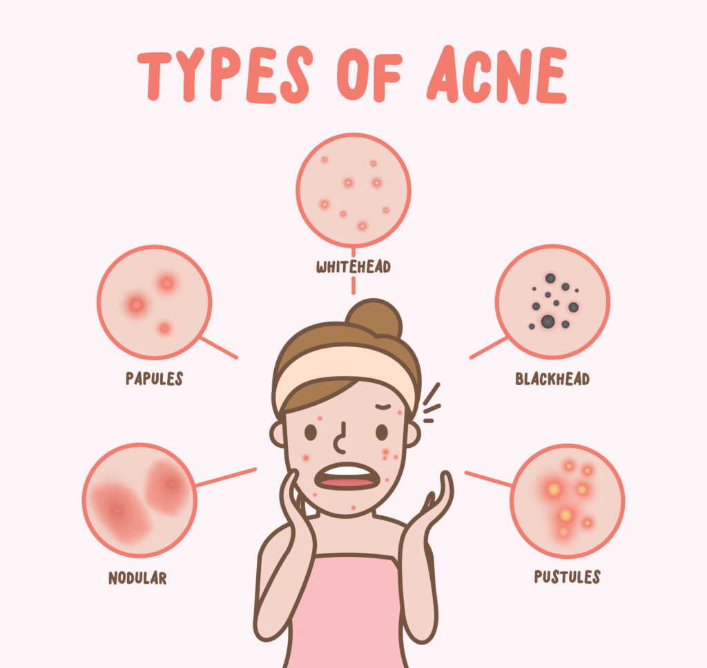 Types of Acnes