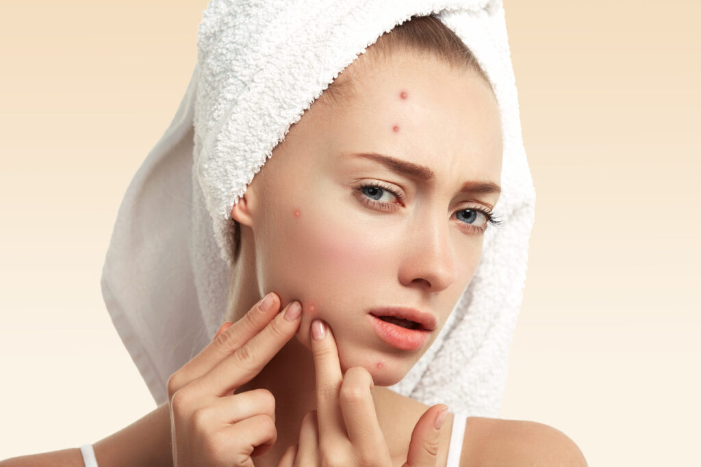 Preventing Pimples: A Complete Guide To Acne