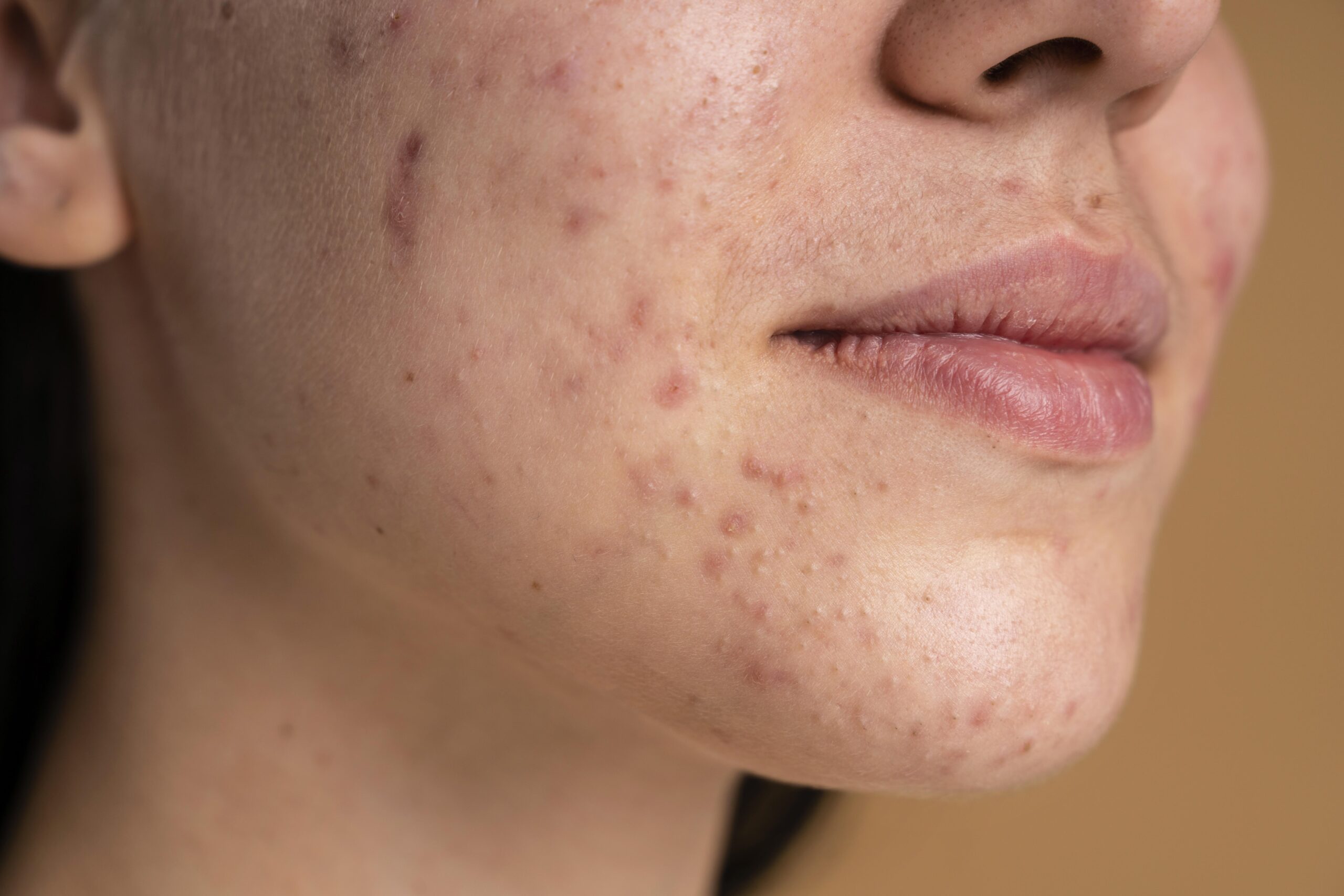 confident-young-woman-with-acne-close-up