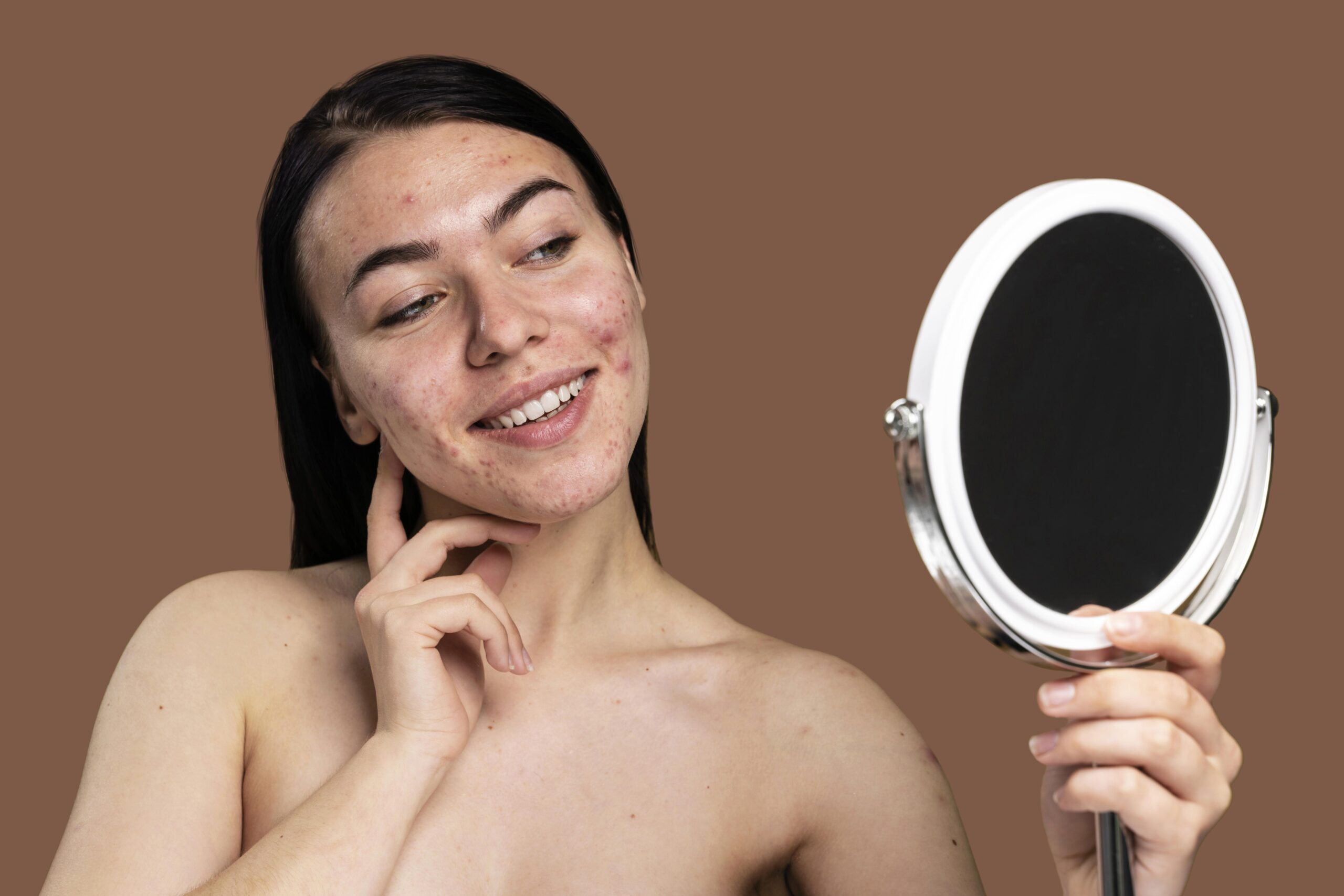 Battling Acne Spots: Real-Life Experiences And Solutions