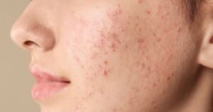 The Hidden Reasons PH, Formulation, and Texture Affect Acne-Prone Skin
