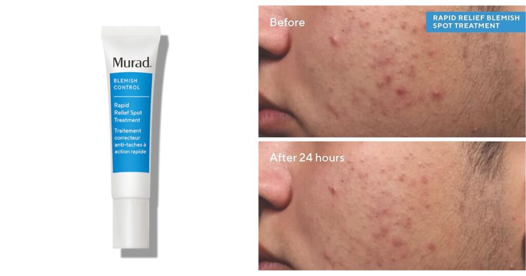 Summer Bum Acne Treatment derm-backed recommendation: Murad: Rapid Relief Spot Treatment