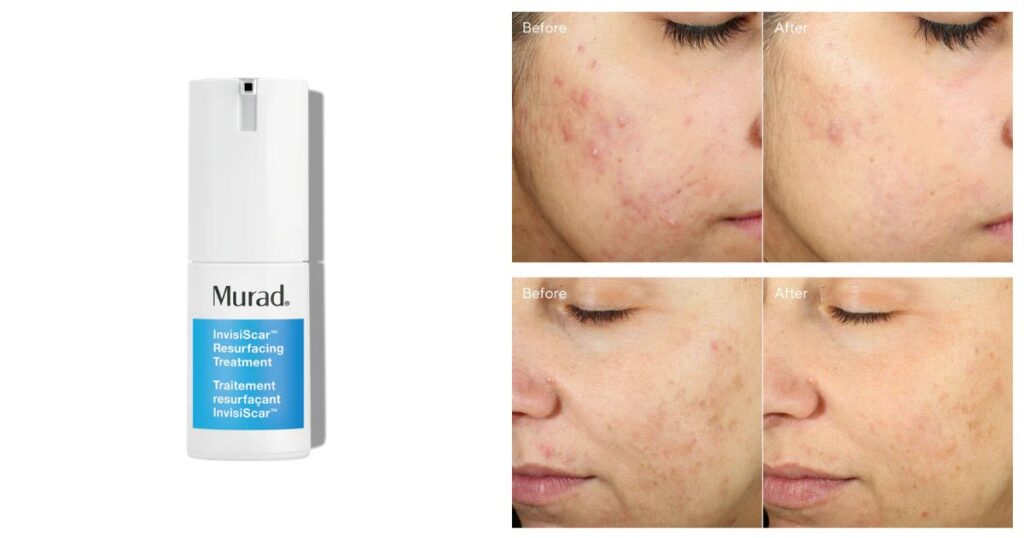 Summer Bum Acne Treatment derm-backed recommendation: Murad: InvisiScar Resurfacing Treatment