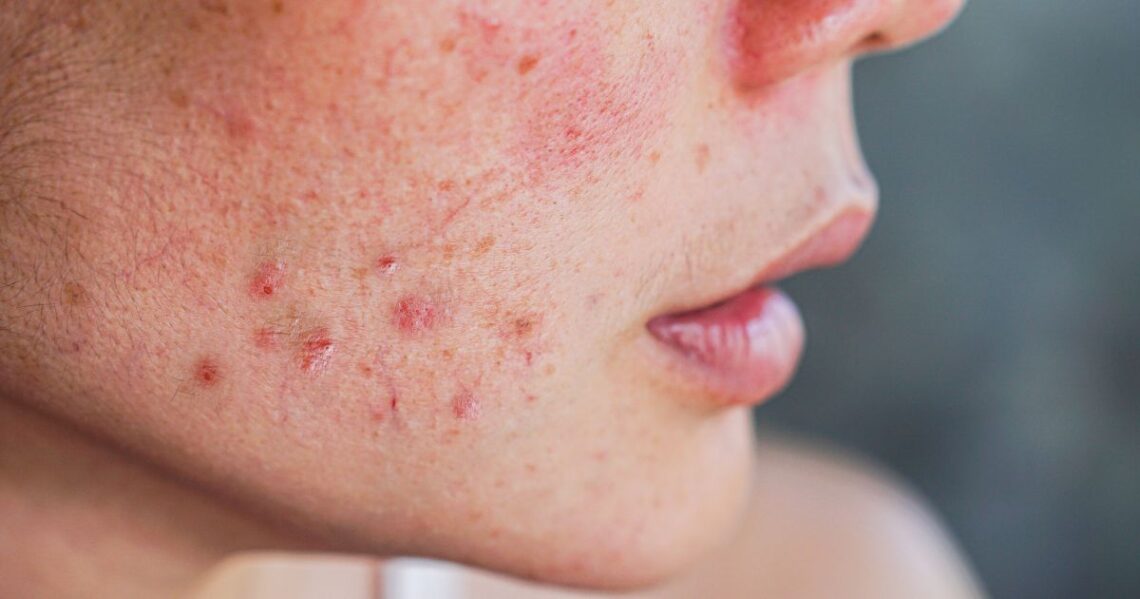 CeraVe vs Cetaphil for Acne: Which Brand Works Best for Breakouts?