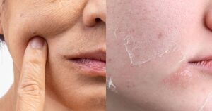 Dry Vs. Dehydrated Skin: Unlock The Secret To Healthier Skin